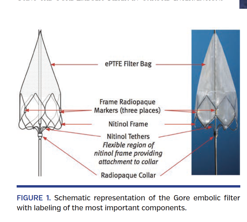 Initial Experience Using the Gore Embolic Filter in Carotid Interventions